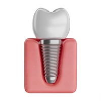 Image of a dental implant bridge