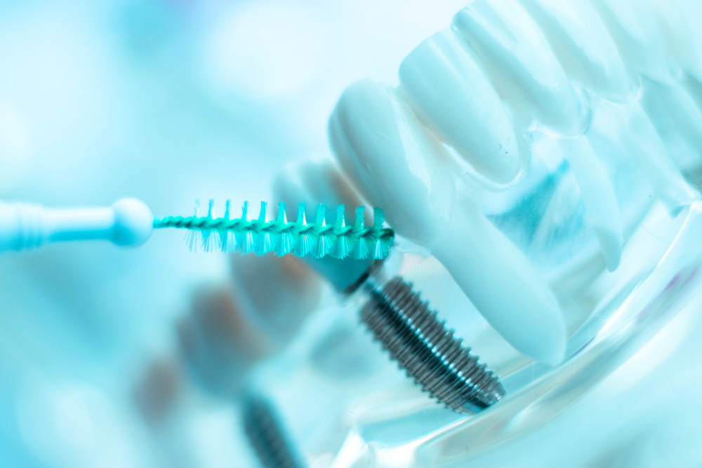 How To Care For And Maintain Dental Implants Dr Dawson